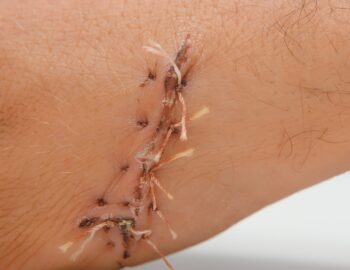 Close-up of a hand wound with stitches