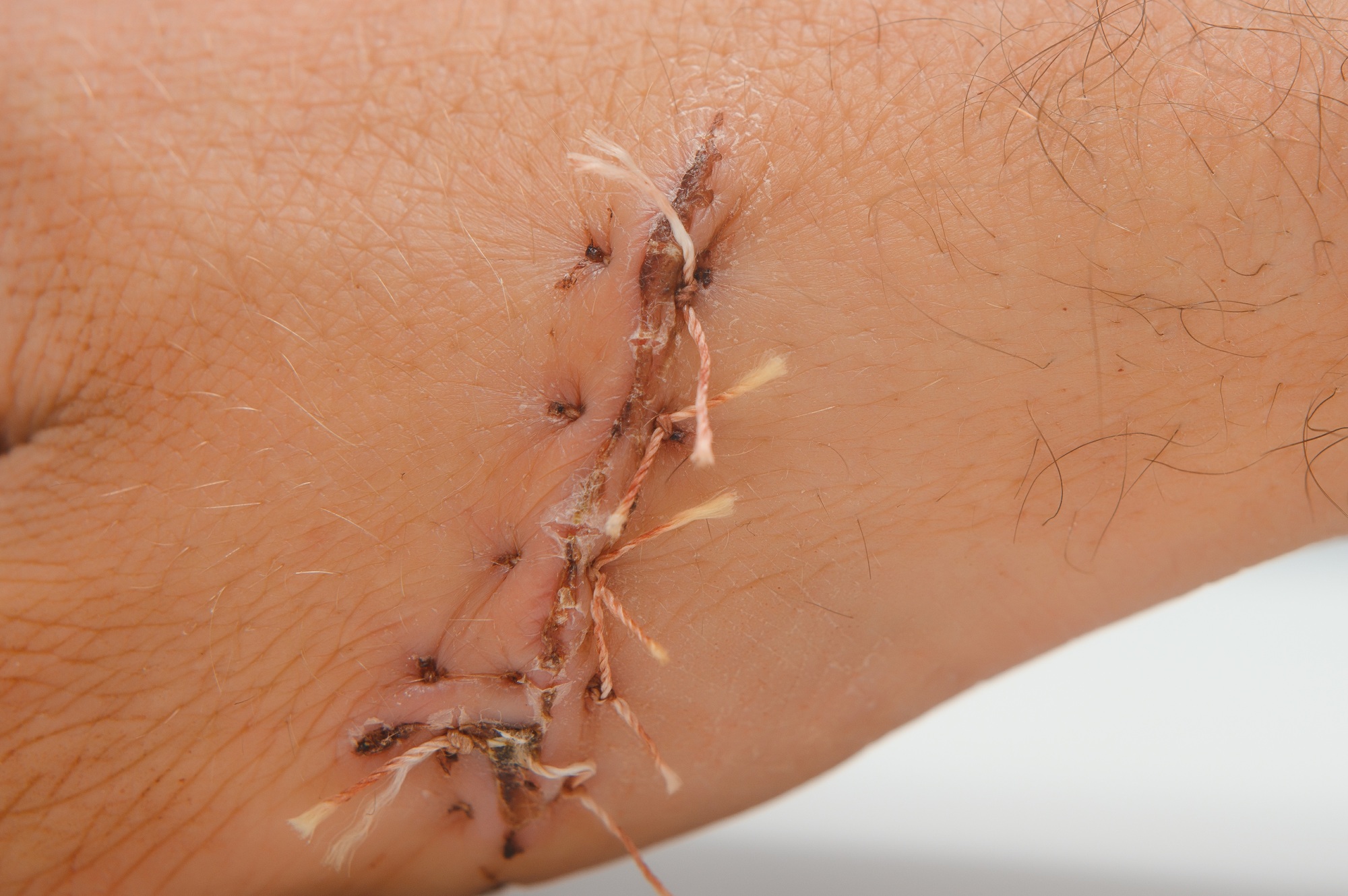 Close-up of a hand wound with stitches