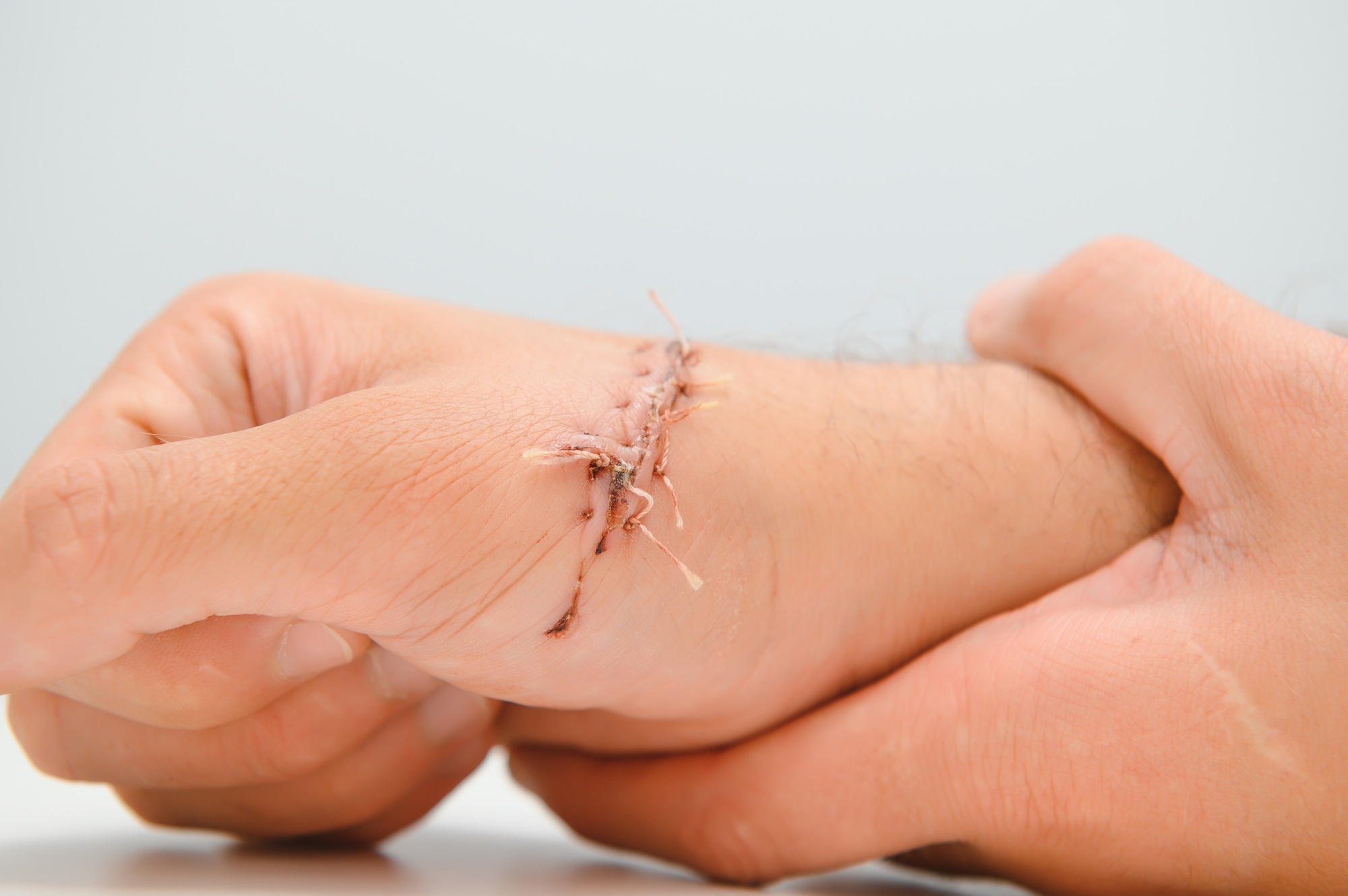 Suture wound on hand,Pain of accident concept