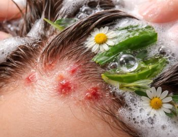 découvrez les causes des boutons sur le cuir chevelu et trouvez les solutions adaptées avec notre guide complet sur les shampoings efficaces pour un cuir chevelu sain.